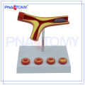 PNT-0725 Arteriosclerosis model of artery Blockage